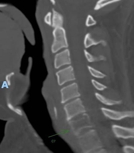 Sagittal (side) view of CT neck with the C7 vertebral body showing low density and compression consistent with pathological fracture due to metastatic cancer.