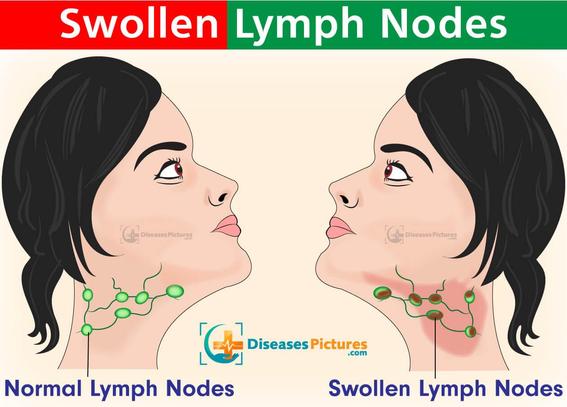 Drawings of two identical women with shortish, pulled back black hair facing each other. Both have their lymph nodes marked on their necks. One is labelled 