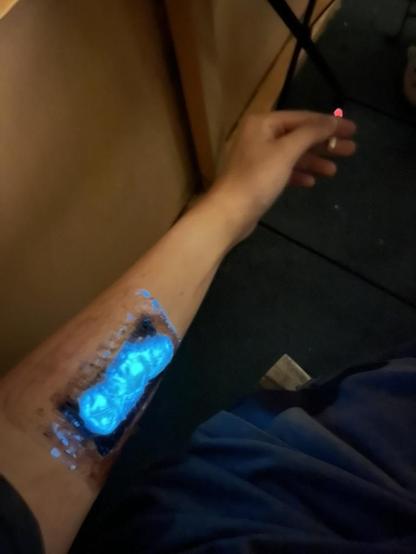 my left arm, glowing bandage over "swag" scar, holding a burning cigarette